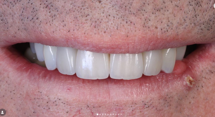 Multiple Implants after treatment